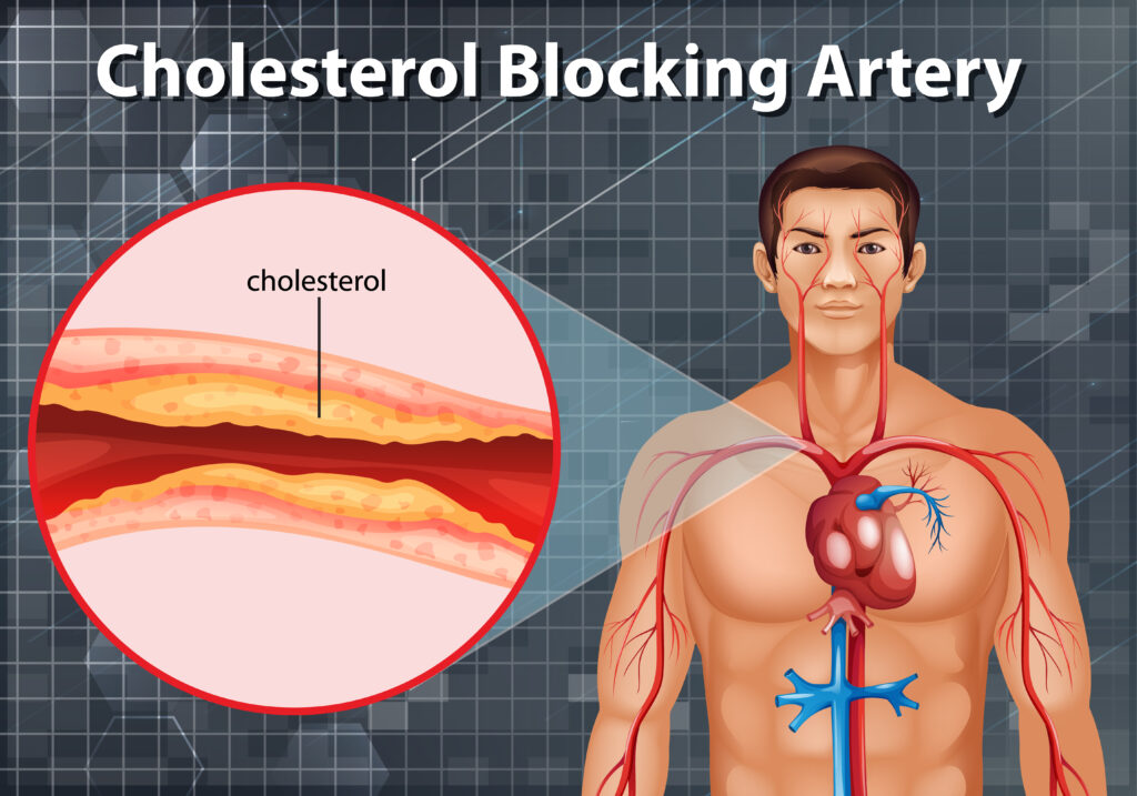 Cholesterol môže zablokovať artérie