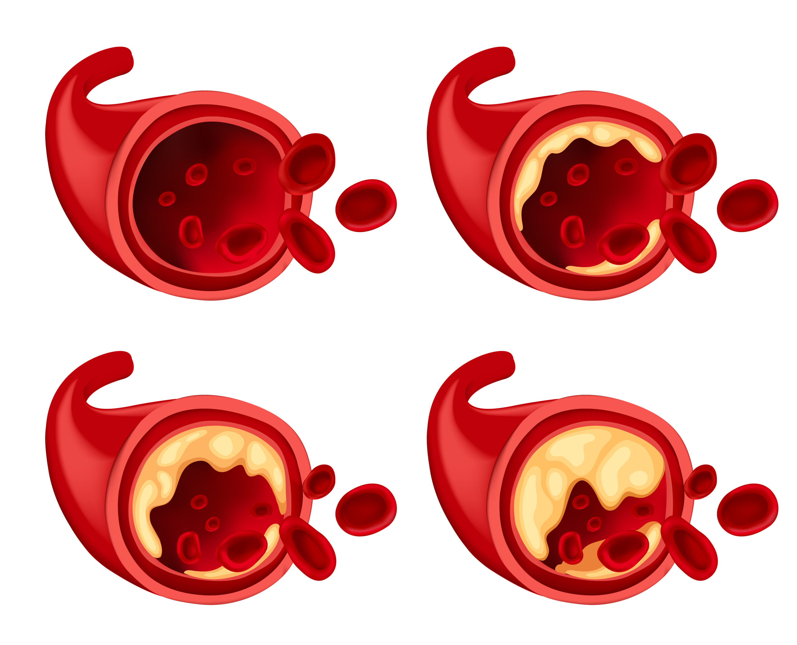 Cholesterol arteria