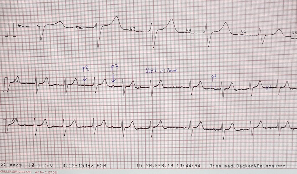 Extrasystola na EKG